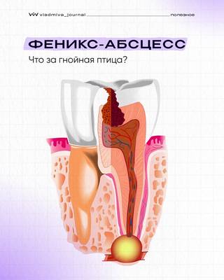 Абсцесс Феникса — предотврати его с ЭндоЖи.